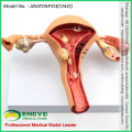 VENDRE 12441 utérus féminin Afficher les pathologies courantes anatomie modèles